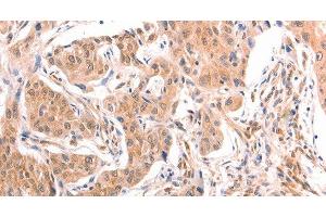 Immunohistochemistry of paraffin-embedded Human lung cancer tissue using TNF beta Polyclonal Antibody at dilution 1:50 (LTA antibody)
