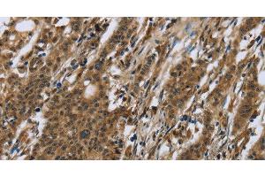 Immunohistochemistry of paraffin-embedded Human gastric cancer using RAP1B Polyclonal Antibody at dilution of 1:50