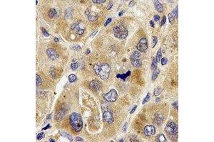 Immunohistochemical analysis of PRODH staining in human liver cancer formalin fixed paraffin embedded tissue section.
