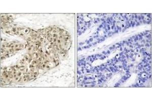 Immunohistochemistry analysis of paraffin-embedded human breast carcinoma, using CDC25C (Phospho-Ser216) Antibody.