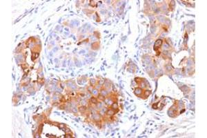 Immunohistochemical staining (Formalin-fixed paraffin-embedded sections) of human breast carcinoma with PIP monoclonal antibody, clone PIP/1571 . (PIP antibody  (AA 41-146))