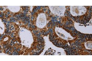 Immunohistochemistry of paraffin-embedded Human colon cancer using NDUFA4 Polyclonal Antibody at dilution of 1:40 (NDUFA4 antibody)