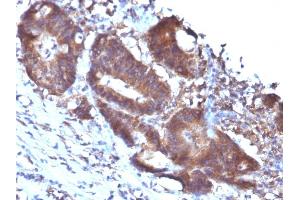 Formalin-fixed, paraffin-embedded human Colon Carcinoma stained with Transgelin Monoclonal Antibody (TAGLN/247) (Transgelin antibody)