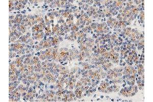 Immunohistochemical staining of paraffin-embedded Carcinoma of Human thyroid tissue using anti-LACTB2 mouse monoclonal antibody. (LACTB2 antibody)