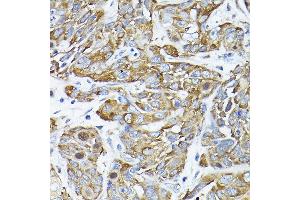 Immunohistochemistry of paraffin-embedded human esophageal cancer using CC2D1A Rabbit pAb (ABIN1679010, ABIN3019218, ABIN3019219 and ABIN6220767) at dilution of 1:200 (40x lens). (CC2D1A antibody  (AA 1-150))