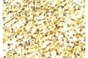 ABIN6273728 at 1/100 staining Human breast cancer tissue by IHC-P.