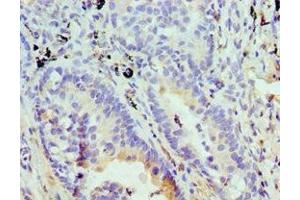 Immunohistochemistry of paraffin-embedded human lung cancer using ABIN7152008 at dilution of 1:100 (Stomatin antibody  (AA 55-288))