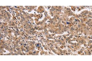 Immunohistochemistry of paraffin-embedded Human liver cancer using KCNG2 Polyclonal Antibody at dilution of 1:40 (Kcng2 antibody)