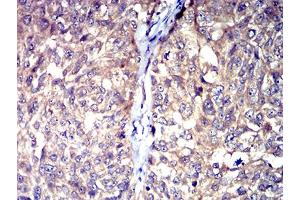 Immunohistochemical analysis of paraffin-embedded bladder cancer tissues using HTR3A mouse mAb with DAB staining.