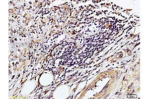Formalin-fixed and paraffin embedded human colon carcinoma labeled with Rabbit Anti-TIMP-1(NT) Polyclonal Antibody, Unconjugated (ABIN668331) at 1:200 followed by conjugation to the secondary antibody and DAB staining. (TIMP1 antibody  (AA 103-207))