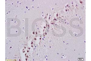 Formalin-fixed and paraffin embedded human colon carcinoma labeled with Rabbit Anti ANP32C Polyclonal Antibody, Unconjugated (ABIN759941) at 1:200 followed by conjugation to the secondary antibody and DAB staining (ANP32C antibody  (AA 81-180))