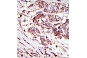 Formalin-fixed and paraffin-embedded human cancer tissue (hepatocarcinoma) reacted with the primary antibody, which was peroxidase-conjugated to the secondary antibody, followed by AEC staining. (CAMK1G antibody  (C-Term))