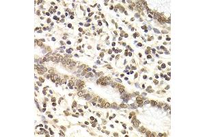 Immunohistochemistry of paraffin-embedded human gastric cancer using LMNB2 Antibody (ABIN2563696) at dilution of 1:200 (40x lens). (Lamin B2 antibody)