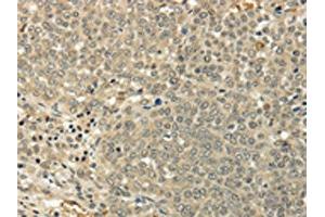 The image on the left is immunohistochemistry of paraffin-embedded Human ovarian cancer tissue using ABIN7128017(SIAH1 Antibody) at dilution 1/35, on the right is treated with fusion protein. (SIAH1 antibody)