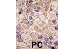 Formalin-fixed and paraffin-embedded human prostate carcinoma tissue reacted with PI4K2B polyclonal antibody  , which was peroxidase-conjugated to the secondary antibody, followed by DAB staining. (PI4K2B antibody  (N-Term))