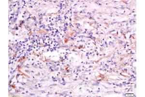 Formalin-fixed and paraffin embedded human lung carcinoma labeled with Anti-GRASP Polyclonal Antibody, Unconjugated  at 1:200 followed by conjugation to the secondary antibody and DAB staining. (Steppke (STEP) (AA 156-260) antibody)