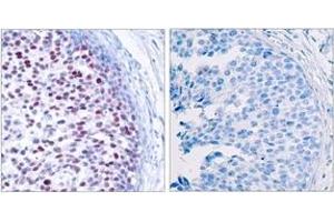 Immunohistochemistry analysis of paraffin-embedded human breast carcinoma, using c-Jun (Phospho-Thr239) Antibody. (C-JUN antibody  (pThr239))