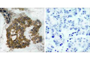 P-Peptide - +Immunohistochemical analysis of paraffin-embedded human lung carcinoma tissue using Akt2 (phospho- Ser474) antibody. (AKT2 antibody  (pSer474))