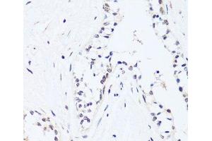 Immunohistochemistry of paraffin-embedded Human breast using BRIX1 Polyclonal Antibody at dilution of 1:100 (40x lens).