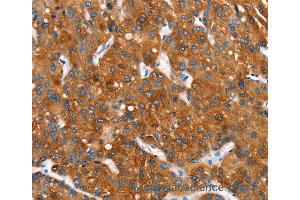 Immunohistochemistry of Human thyroid cancer using MT-CYB Polyclonal Antibody at dilution of 1:30