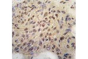 IHC analysis of FFPE human breast carcinoma tissue stained with Cyclin D1 antibody (Cyclin D1 antibody  (AA 68-97))