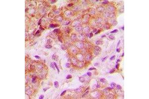 Immunohistochemical analysis of MRPS22 staining in human breast cancer formalin fixed paraffin embedded tissue section. (MRPS22 antibody)