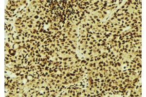 ABIN6277089 at 1/100 staining Human breast cancer tissue by IHC-P. (PIN1 antibody  (N-Term))