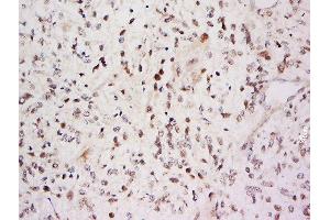 Formalin-fixed and paraffin embedded Glioma cell tumor labeled with Anti-SARA Polyclonal Antibody, Unconjugated  at 1:500 followed by conjugation to the secondary antibody and DAB staining.