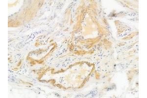 ABIN6256659 and ABIN6267529 at 1/100 staining human testicular cancer by IHC-P. (JNK antibody  (pTyr185))