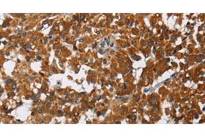 Immunohistochemistry of paraffin-embedded Human thyroid cancer using CAT Polyclonal Antibody at dilution of 1:40 (Catalase antibody)