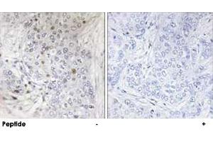 Immunohistochemistry analysis of paraffin-embedded human breast carcinoma tissue, using MAFF polyclonal antibody . (MafF antibody)