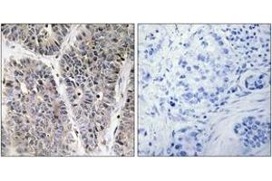 Immunohistochemistry analysis of paraffin-embedded human lung carcinoma tissue, using NBL1 Antibody. (NBL1 antibody  (AA 131-180))