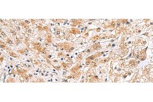 Immunohistochemistry of paraffin-embedded Human liver cancer tissue using PDCL2 Polyclonal Antibody at dilution of 1:65(x200) (PDCL2 antibody)