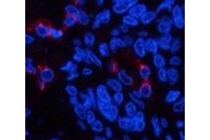 Immunofluorescence analysis of Human lung cancer tissue using LTF Monoclonal Antibody at dilution of 1:200. (Lactoferrin antibody)