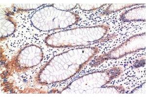 Immunohistochemistry of paraffin-embedded Human colon carcinoma tissue with Phospho-MLKL (Ser358) Monoclonal Antibody at dilution of 1:200 (MLKL antibody  (pSer358))