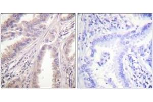 Immunohistochemistry analysis of paraffin-embedded human lung carcinoma tissue, using KIF11/Eg5 (Ab-927) Antibody. (KIF11 antibody  (AA 892-941))