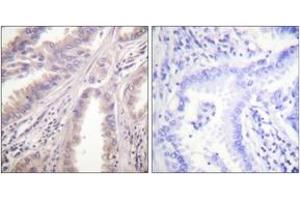 Immunohistochemistry analysis of paraffin-embedded human lung carcinoma tissue, using KIF11/Eg5 (Ab-927) Antibody. (KIF11 antibody  (AA 892-941))