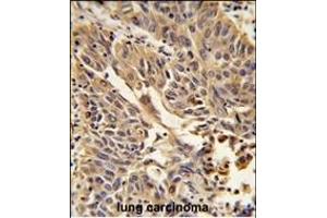 Formalin-fixed and paraffin-embedded human lung carcinoma reacted with JUP Antibody (C-term), which was peroxidase-conjugated to the secondary antibody, followed by DAB staining. (JUP antibody  (C-Term))