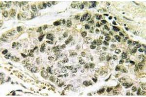 Immunohistochemistry (IHC) analyzes of p-SNAI 1 antibody in paraffin-embedded human lung carcinoma tissue. (SNAIL antibody  (pSer246))