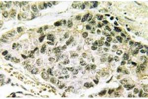 Immunohistochemistry (IHC) analyzes of p-SNAI 1 antibody in paraffin-embedded human lung carcinoma tissue.