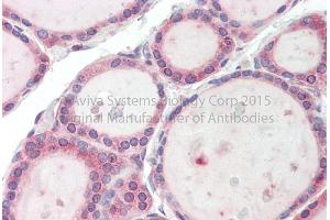 Rabbit Anti-TBC1D4 Antibody Catalog Number: ARP63880 Formalin Fixed Paraffin Embedded Tissue: Human Adult Thyroid  Observed Staining: Cytoplasm in hepatocytes Primary Antibody Concentration: 1:600 Secondary Antibody: Donkey anti-Rabbit-Cy3 Secondary Antibody Concentration: 1:200 Magnification: 20X Exposure Time: 0. (TBC1D4 antibody  (C-Term))