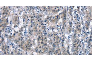 Immunohistochemistry of paraffin-embedded Human gastric cancer tissue using CD226 Polyclonal Antibody at dilution 1:60 (CD226 antibody)