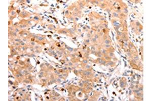 The image on the left is immunohistochemistry of paraffin-embedded Human lung cancer tissue using ABIN7190209(CELSR2 Antibody) at dilution 1/50, on the right is treated with synthetic peptide. (CELSR2 antibody)
