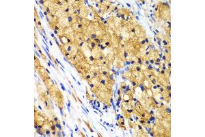 Immunohistochemistry of paraffin-embedded human lung cancer using CAPG Antibody. (CAPG antibody)