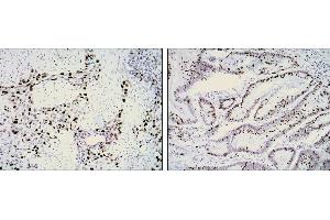 Immunohistochemical analysis of paraffin-embedded lung cancer (left) and rectal cancer (right) using KI67 mouse mAb with DAB staining. (Ki-67 antibody)