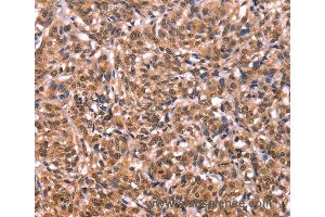 Immunohistochemistry of Human liver cancer using ESRRB Polyclonal Antibody at dilution of 1:40 (ESRRB antibody)