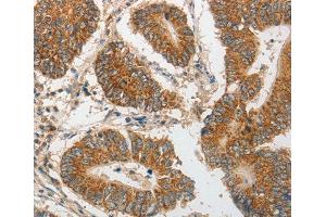 Immunohistochemistry (IHC) image for anti-Progesterone Immunomodulatory Binding Factor 1 (PIBF1) antibody (ABIN3023472) (PIBF1 antibody)