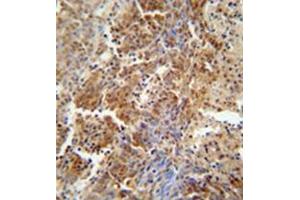 Formalin fixed and paraffin embedded human lung carcinoma reacted with ERCC8 Antibody  followed by peroxidase conjugation of the secondary antibody and DAB staining.