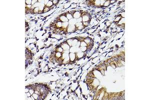 Immunohistochemistry of paraffin-embedded human colon using COX2/PTGS2 Rabbit pAb (ABIN6130125, ABIN6146415, ABIN6146417 and ABIN6216190) at dilution of 1:50 (40x lens). (PTGS2 antibody  (AA 375-604))
