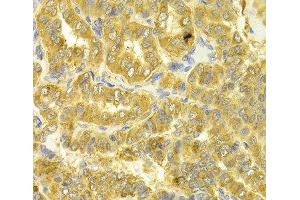 Immunohistochemistry of paraffin-embedded Human thyroid cancer using DLD Polyclonal Antibody at dilution of 1:100 (40x lens).